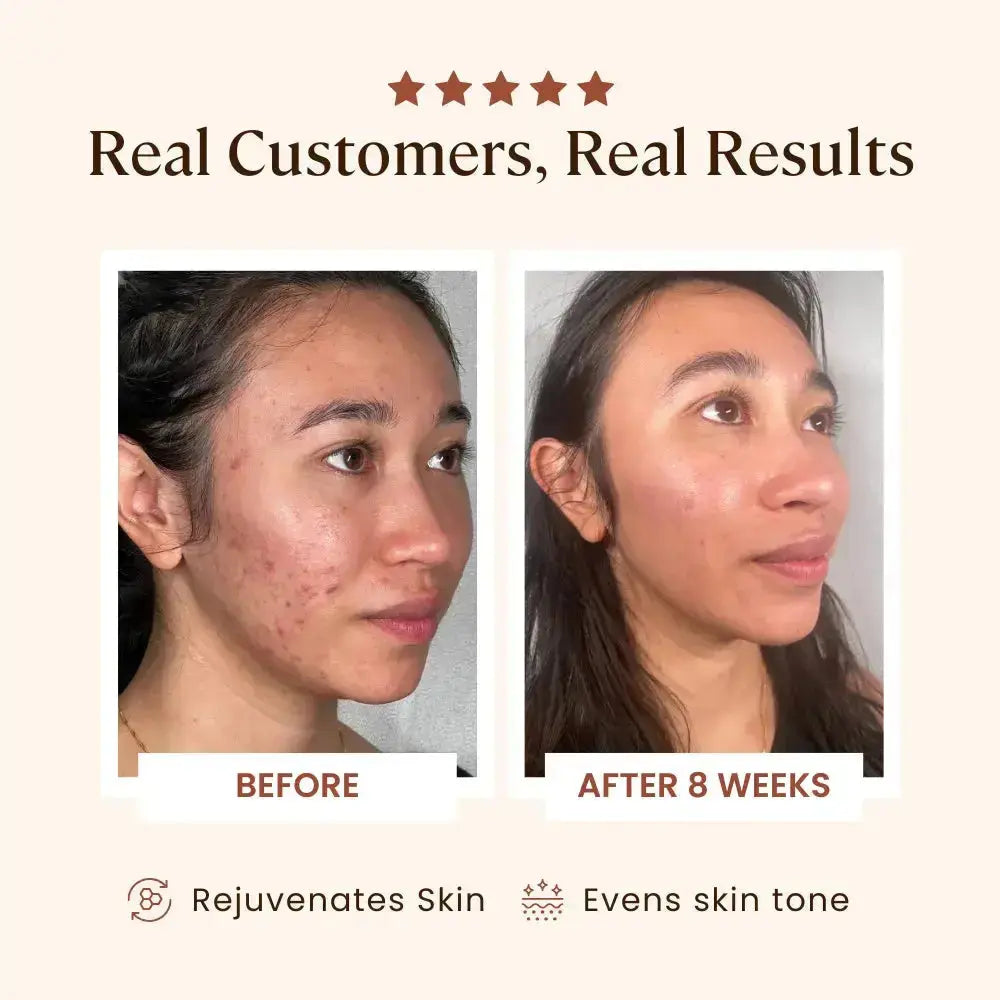 Plasma Skin Perfector - Sale